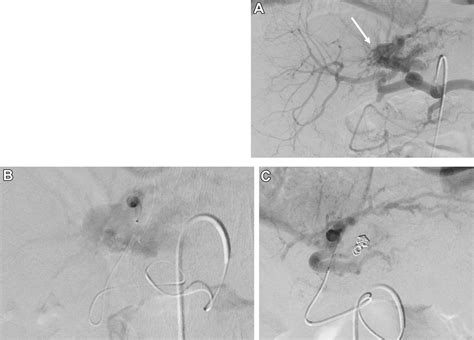 Interventional Radiology Management Of Adult Liver Transplant