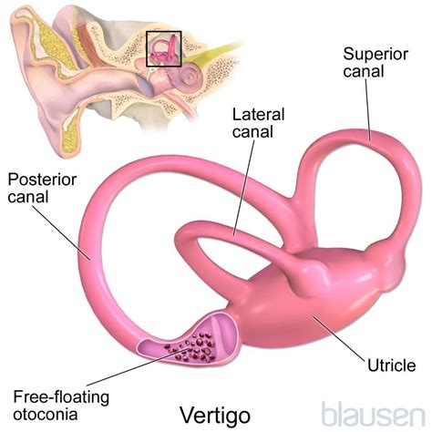 Benign Paroxysmal Positional Vertigo Ear Nose And Throat Disorders Merck Manuals Consumer