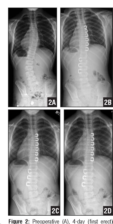 Figure 1 From Early Onset Scoliosis Semantic Scholar