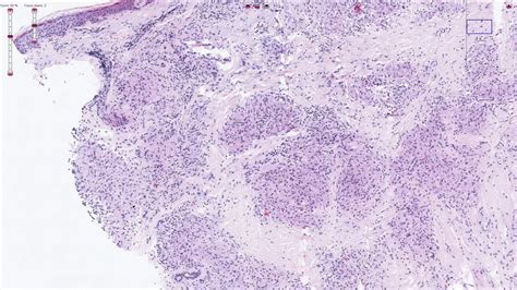 Skin Histology Sarcoidosis