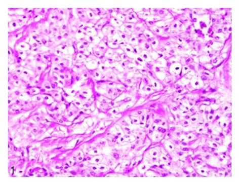 A Showing Solid Variant Of Clear Cell Adenocarcinoma Of The Bladder