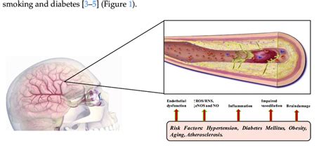 The Pathophysiology Of Arcsvd Is Complex And Involves Various Players