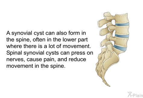 Patedu Spinal Synovial Cysts