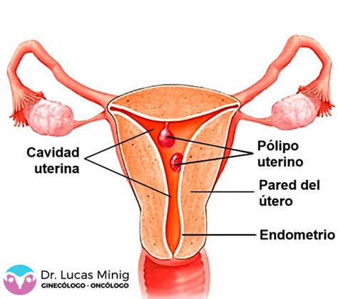 Pólipos Uterinos