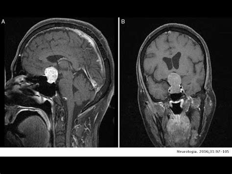 Adenoma Hipofisario Hipersecretor De Prolactina YouTube