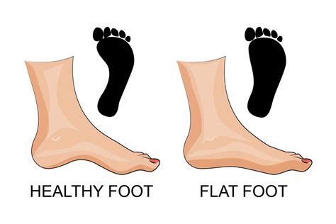 Flat Feet Comfort Feet Podiatry Group