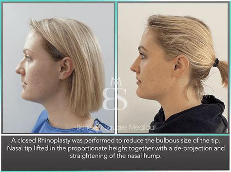 Rhinoplasty Before After London 34 - Berkeley Square Medical - Central ...