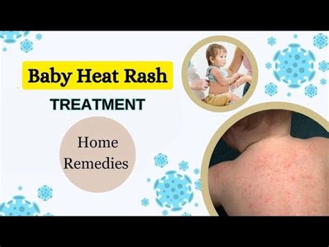 Baby Heat Rashes Treatment Baby Heat Rash Home Remedy Garmi Dano Ka