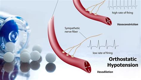 5 Ways To Prevent Propranolol Orthostatic Hypotension