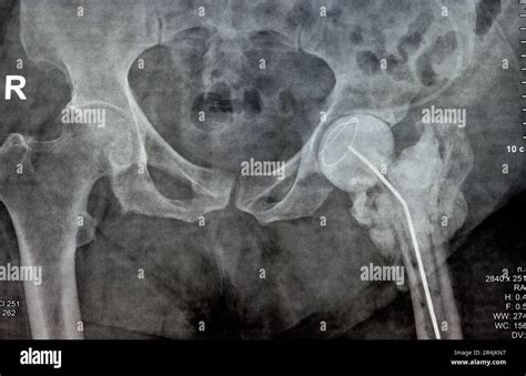 Plain X Ray Hip Joint Show Left Trans Cervical Fracture Of The Head Of