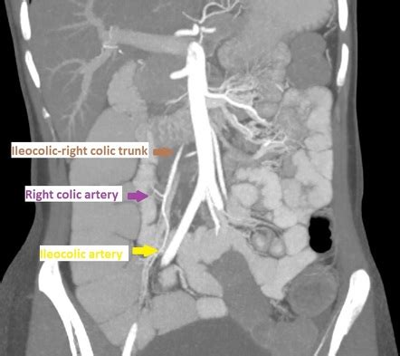 Sma Syndrome Anatomy