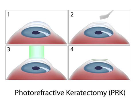 PRK LASEK Treatment - Refractive Surgery | Boston Laser in Boston, MA