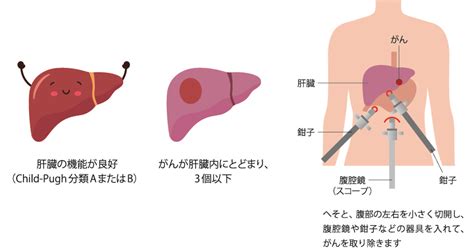 肝細胞がんの治療の種類｜plus Chugai 中外製薬医療関係者向けサイト（医師向け）