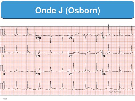 D Finitions Page Sur E Cardiogram