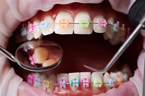 Fun Braces Colors for Kids | Orthodontist in Ft. Collins