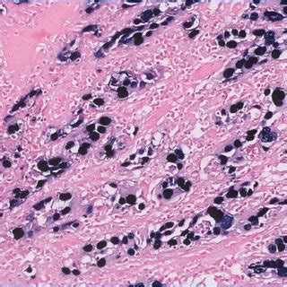 Different shapes of the epiglottis. a Type 1—omega-shaped epiglottis; b ...