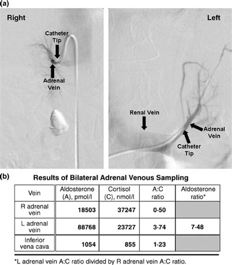 What Are The Keys To Successful Adrenal Venous Sampling AVS In