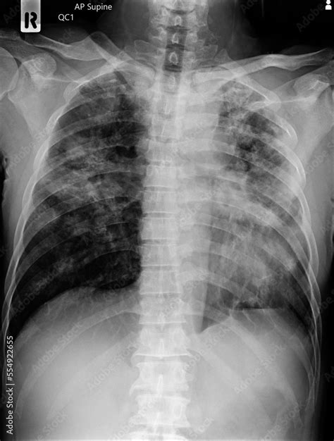 Film Chest Of A Patient With Left Lung Pneumonia And Pleural Effusion