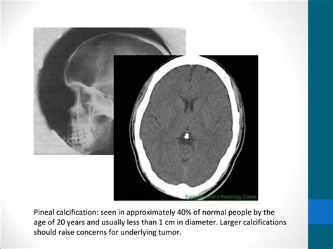 Pineal gland tumors