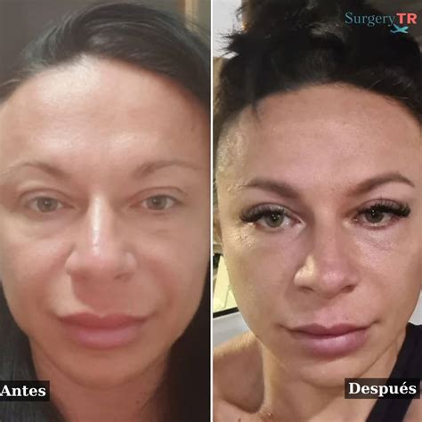 Lifting Facial En Turqu A Lifting De Cara Surgerytr