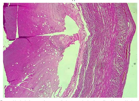 Figure 2 From Treatment And Evolution Of Appendicular Mucoceles In Six