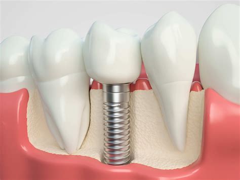 Dental Bone Graft Recovery Pain at Dorla Walker blog