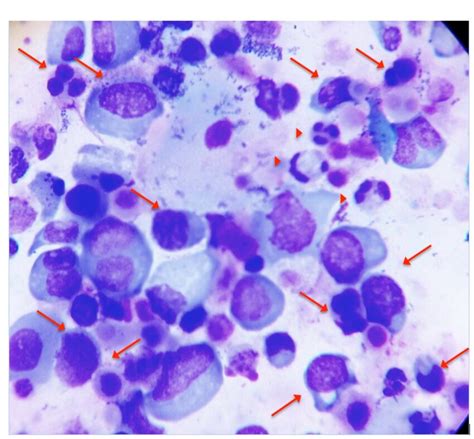 Immature Germ Cells Arrow And Leukocytes Arrowhead In Semen From A