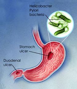 Helicobacter Pylori - United Digestive