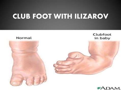 Club Foot With Ilizarov Ppt