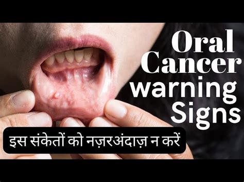 First Signs Of Mouth Cancer Pictures In Hindi Infoupdate Org