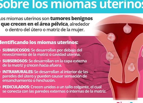 Diferencias Entre Fibroma Y Mioma Todo Lo Que Debes Saber Para Identificarlos Correctamente