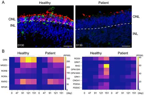 Generation Of Human Patient IPSC Derived Retinal Organoids To Model