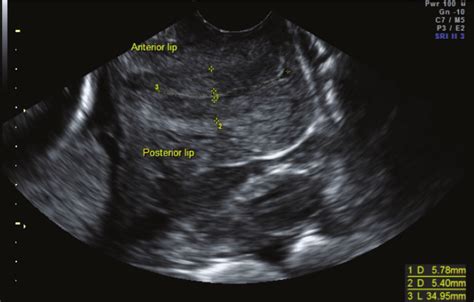 Transvaginal image of the maternal pelvis demonstrating cervical... | Download Scientific Diagram