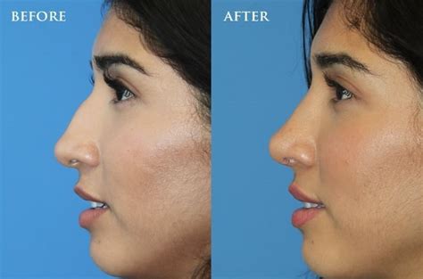 Rhinoplasty