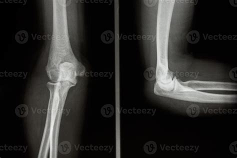 Elbow Anatomy Xray