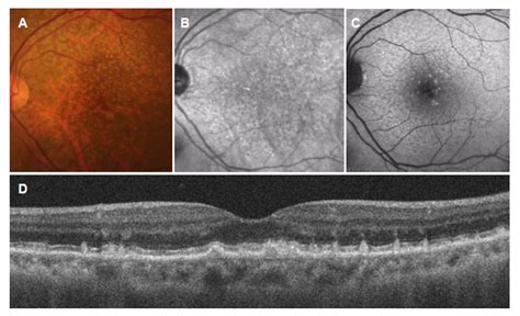 Subretinal Drusenoid Deposits SDDs A Color Fundus Photograph