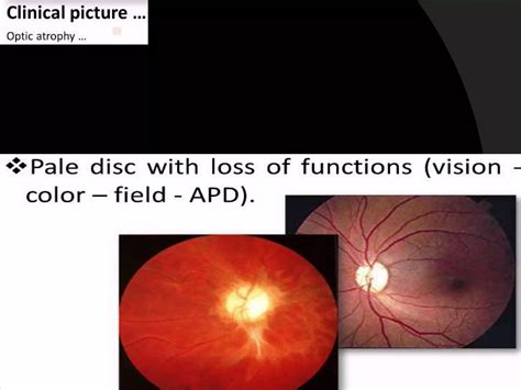 optic nerve optic atrophy clinical