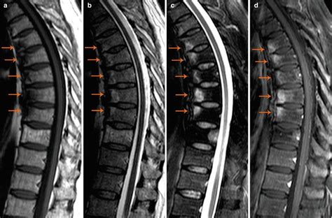 Psoriatic Spondylitis | Radiology Key