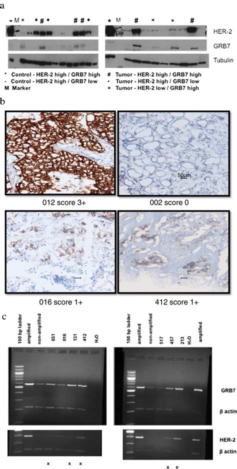 Grb7 And Her 2 Expression In Frozen Breast Tumor Tissues A Grb7 And