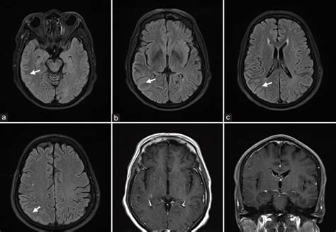 Brain Mri With Anti Mog Associated Cerebral Cortical Encephalitis After Download Scientific