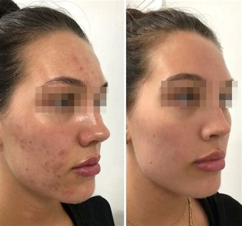 Suavicid Antes E Depois Melasma Manchas E Espinhas