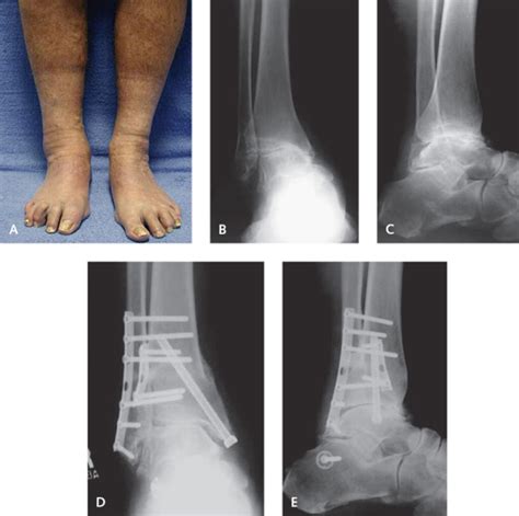 Osteotomy Of The Tibia And Fibula Musculoskeletal Key