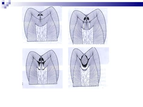 Clinical Features And Histopathology Of Dental Caries Ppt