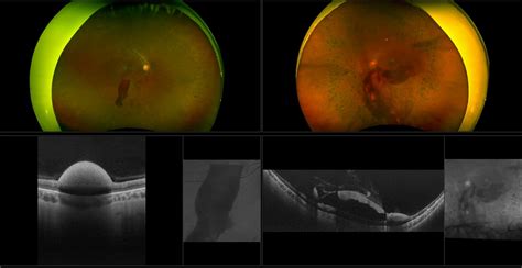 Silverstone Diabetic Macular Edema With Active Pdr Rg Af Oct