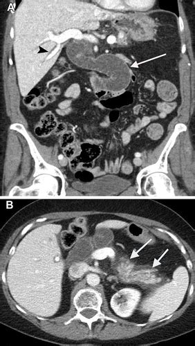 Imaging After Pancreatic Surgery Expected Findings And Postoperative