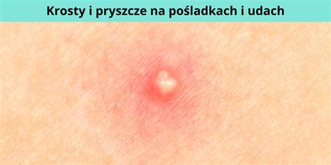 Krosty i pryszcze na pośladkach i udach skąd się biorą