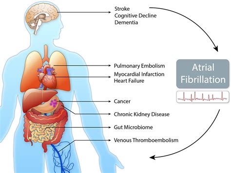 Epidemiology Of Atrial Fibrillation In The St Century Circulation