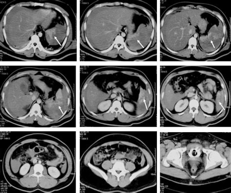 Delayed Diagnosis Of Splenic Injury Radiology Cases