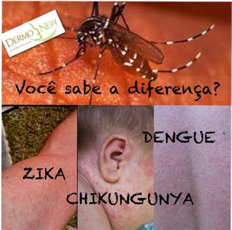 Dengue Zika V Rus E Chikungunya Saiba Diferenciar Os Sintomas