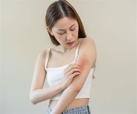 Spongiotic Dermatitis All You Need To Know